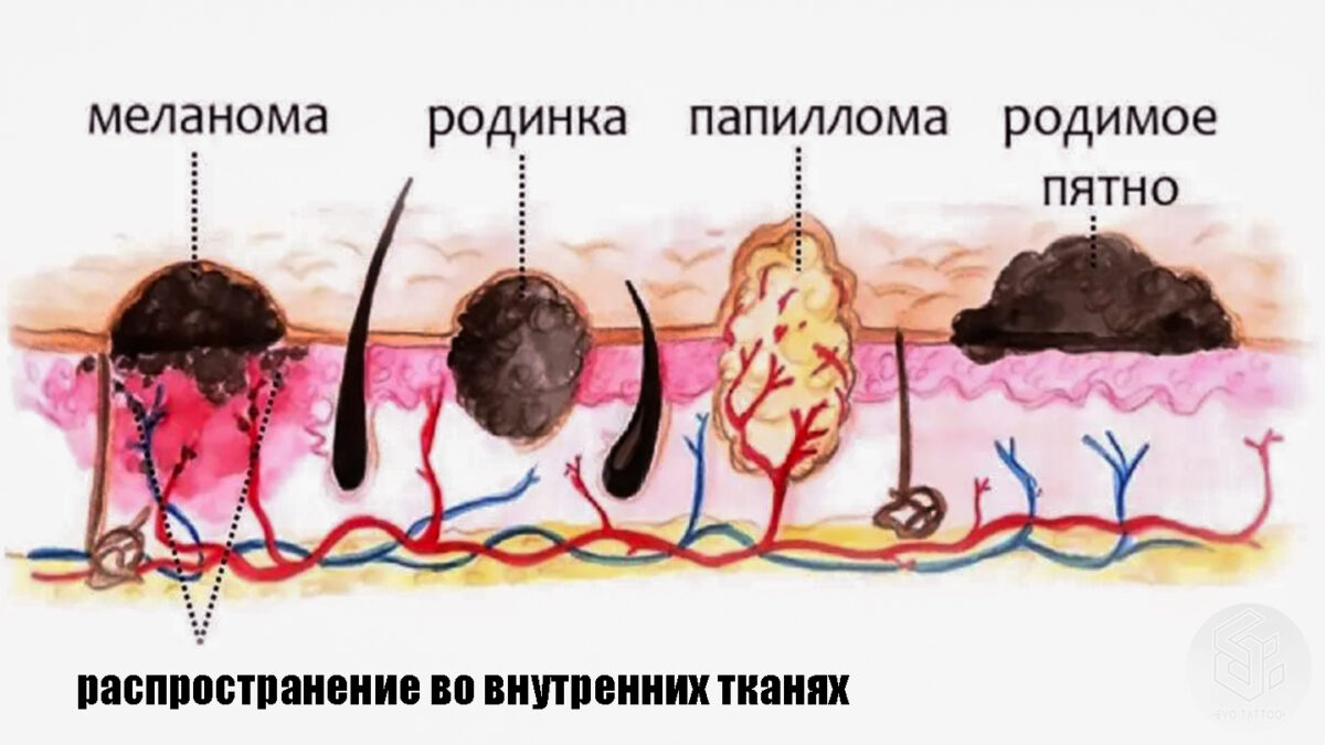 виды невусов